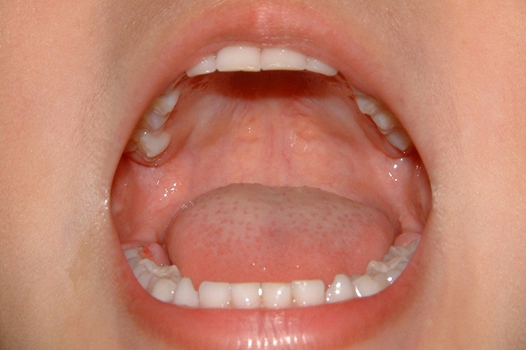 歯並びと顎骨の発育・呼吸面の関係